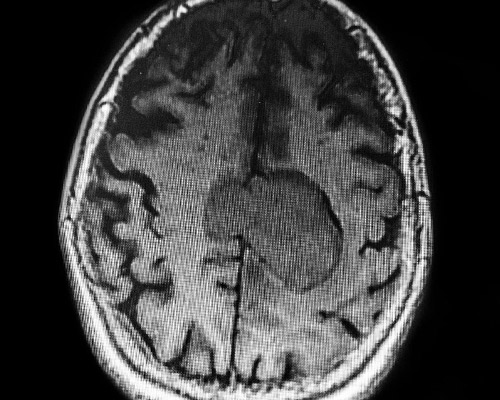 Black and white brain image with tumor