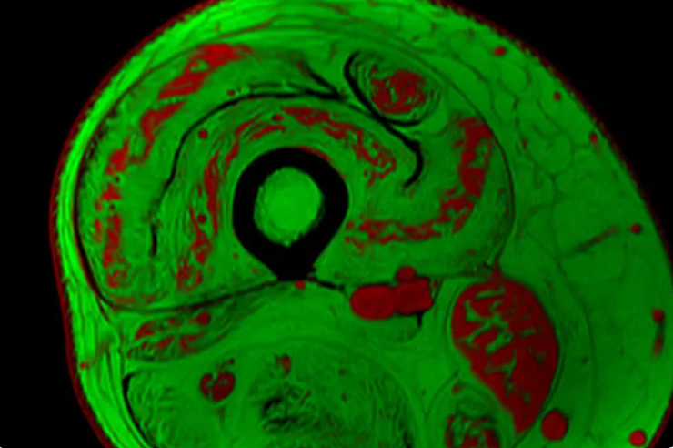 Cross section of thigh muscle of a person with muscular dystrophy